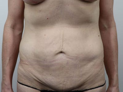 Tummy Tuck Before & After Gallery - Patient 87555410 - Image 1