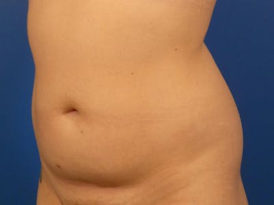 Liposuction Before & After Gallery - Patient 87555409 - Image 1