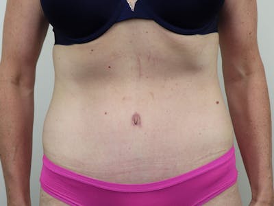Tummy Tuck Before & After Gallery - Patient 87555410 - Image 2