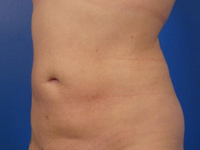Liposuction Before & After Gallery - Patient 87555409 - Image 2