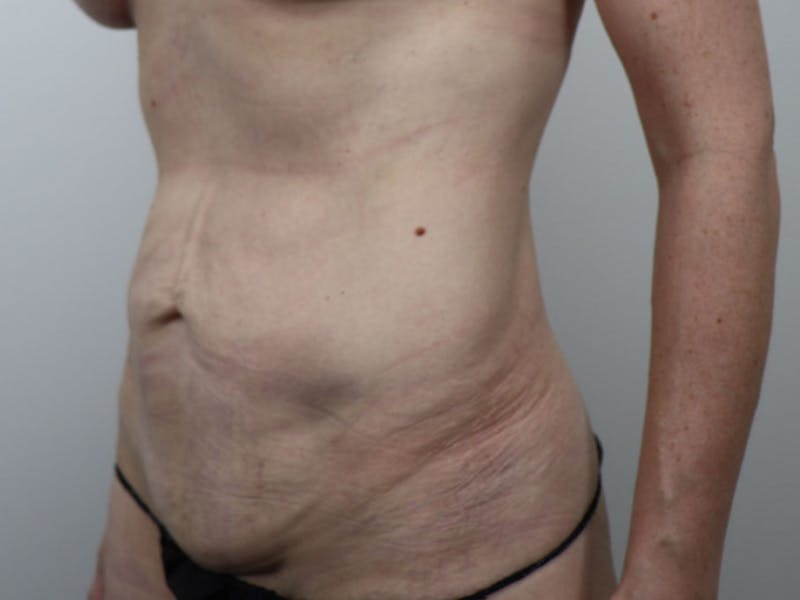 Tummy Tuck Before & After Gallery - Patient 87555410 - Image 3