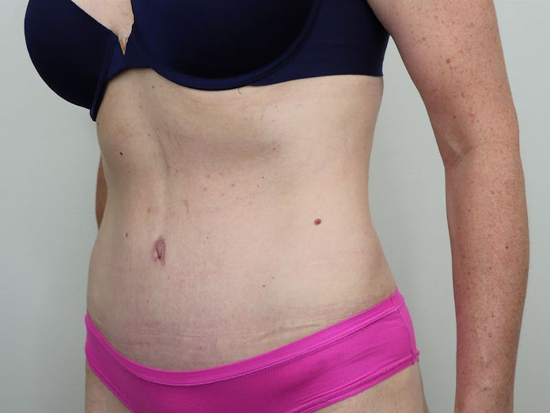 Tummy Tuck Before & After Gallery - Patient 87555410 - Image 4