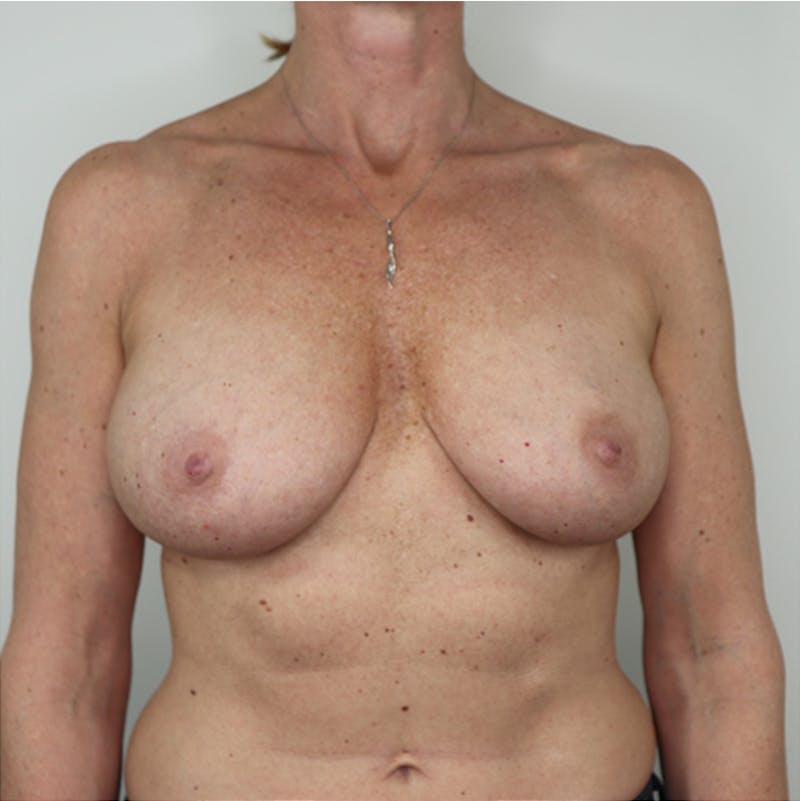 Breast Augmentation Before & After Gallery - Patient 87555412 - Image 3