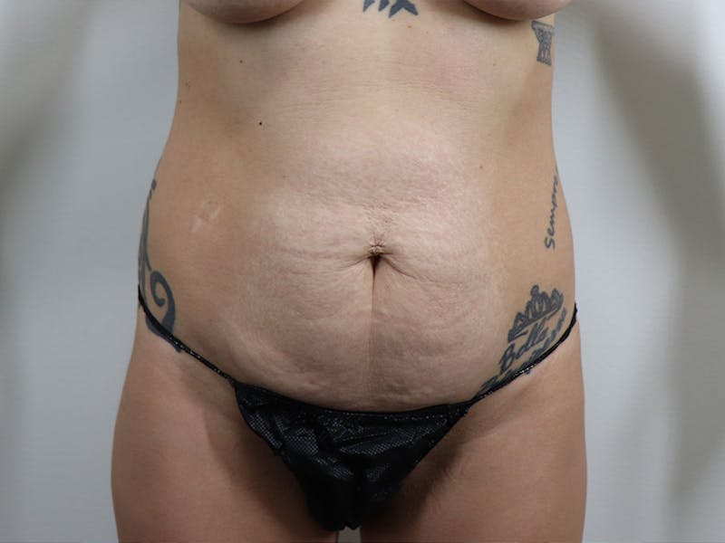 Tummy Tuck Before & After Gallery - Patient 87555414 - Image 1