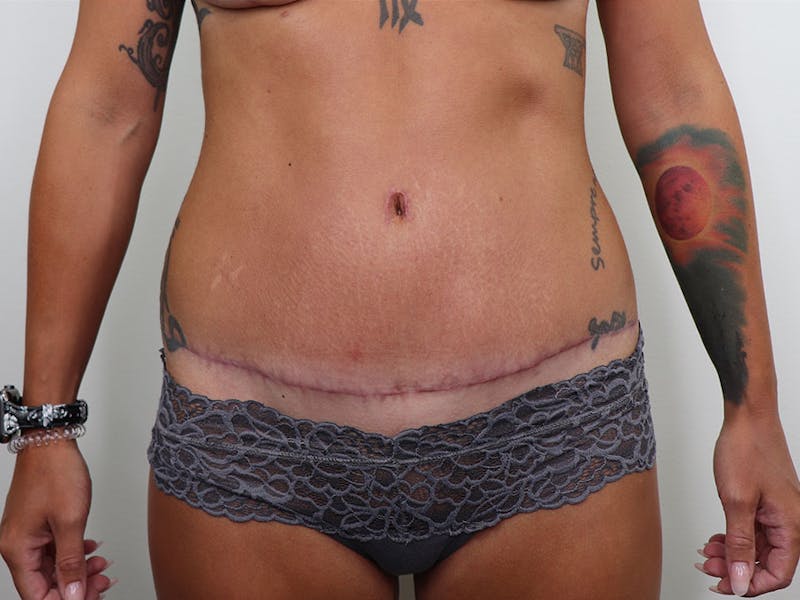 Tummy Tuck Before & After Gallery - Patient 87555414 - Image 2