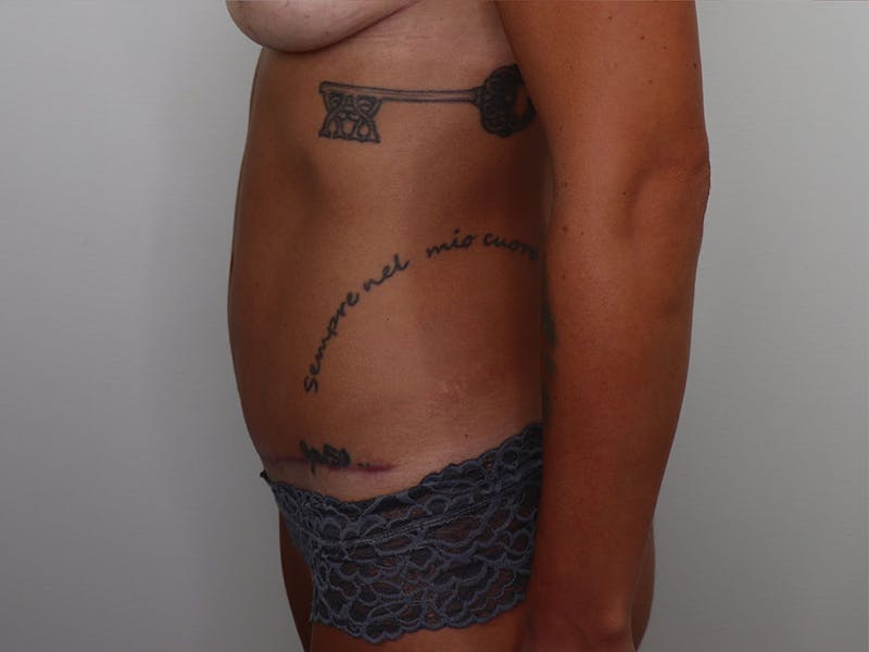 Tummy Tuck Before & After Gallery - Patient 87555414 - Image 4