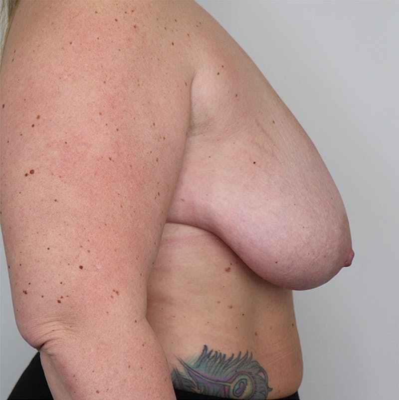 Breast Lift Before & After Gallery - Patient 87555422 - Image 1