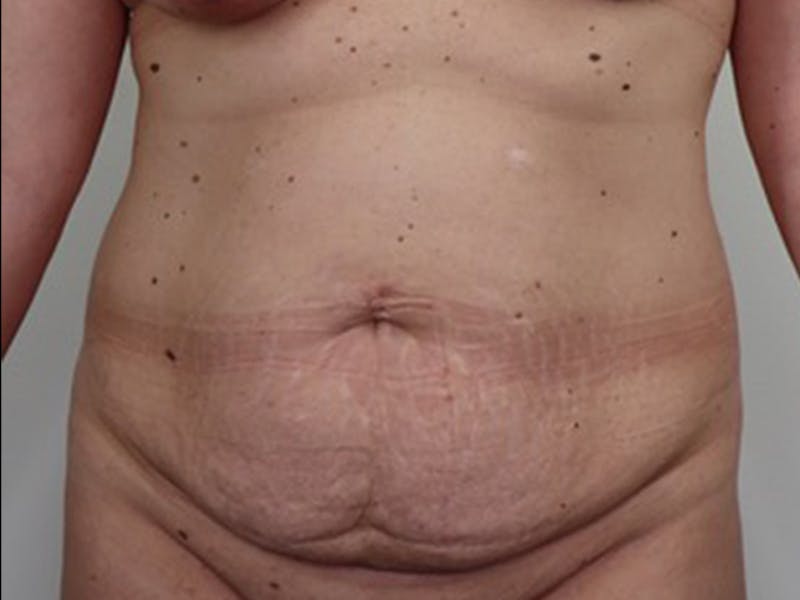 Tummy Tuck Before & After Gallery - Patient 87555416 - Image 1