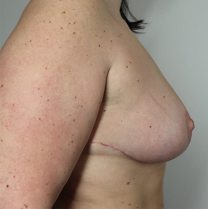 Breast Lift Before & After Gallery - Patient 87555422 - Image 2