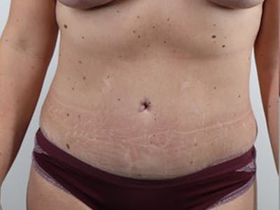Tummy Tuck Before & After Gallery - Patient 87555416 - Image 2