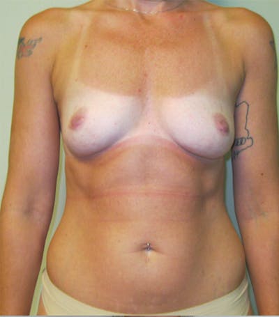 Breast Augmentation Before & After Gallery - Patient 87555420 - Image 1