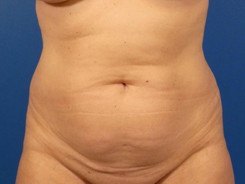 Tummy Tuck Before & After Gallery - Patient 87555421 - Image 1