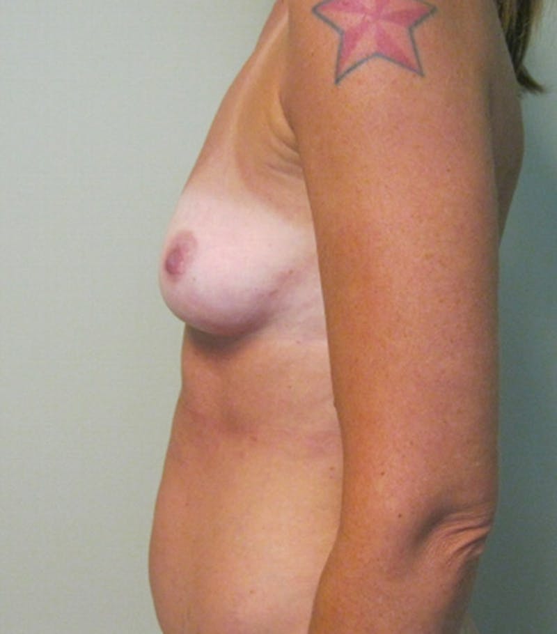 Breast Augmentation Before & After Gallery - Patient 87555420 - Image 3