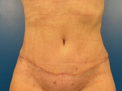 Tummy Tuck Before & After Gallery - Patient 87555421 - Image 2