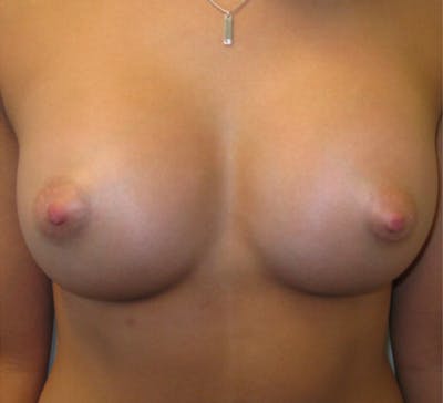 Breast Augmentation Before & After Gallery - Patient 87555436 - Image 2