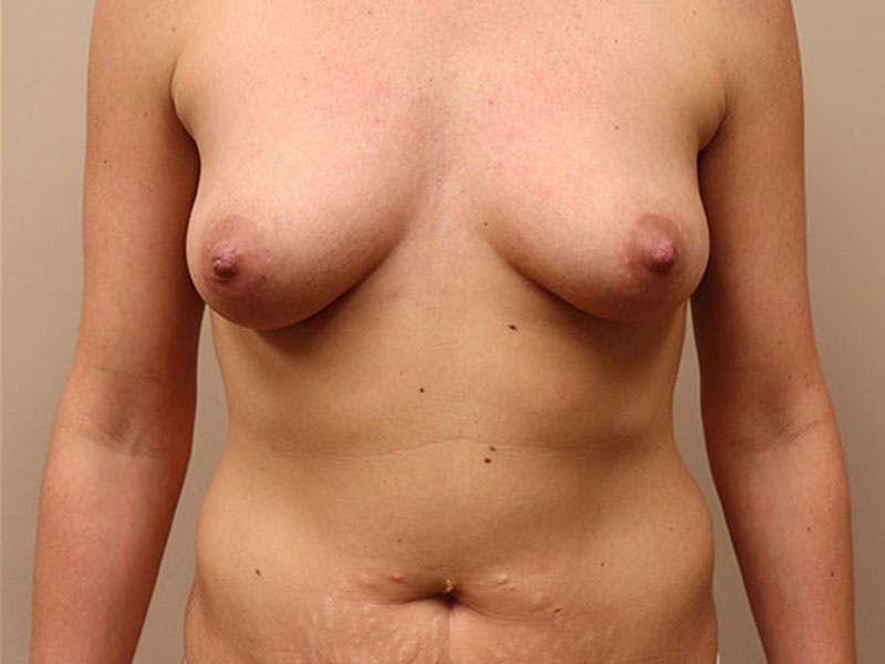 Breast Augmentation Before & After Gallery - Patient 87555440 - Image 1
