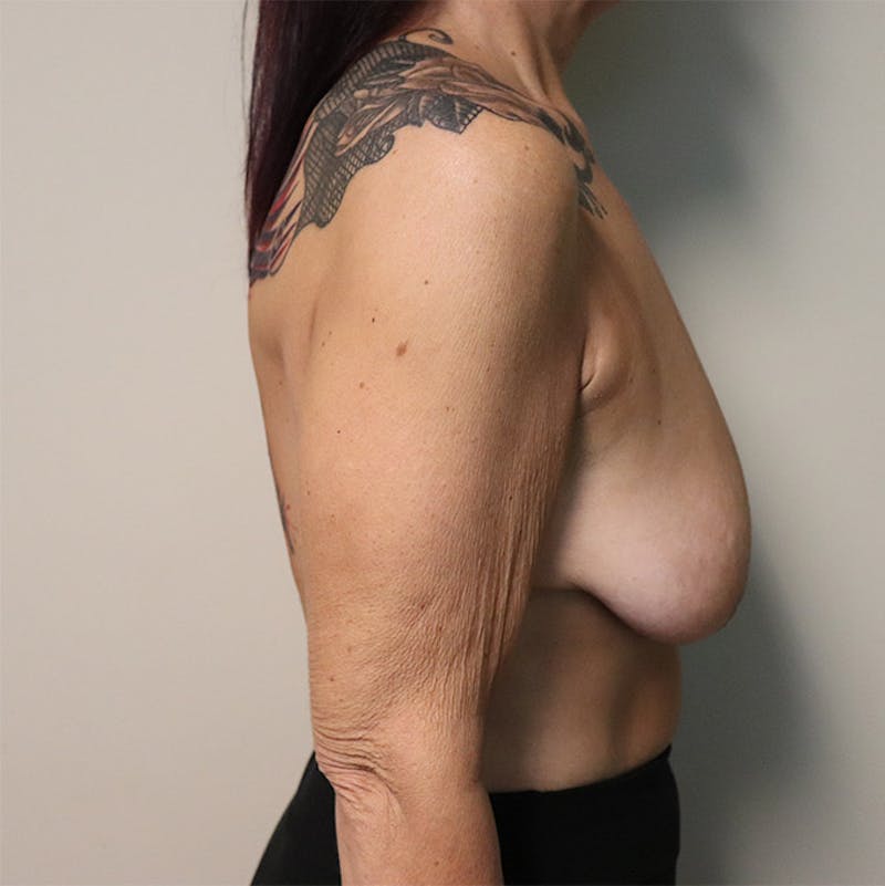 Breast Lift Before & After Gallery - Patient 87555438 - Image 5