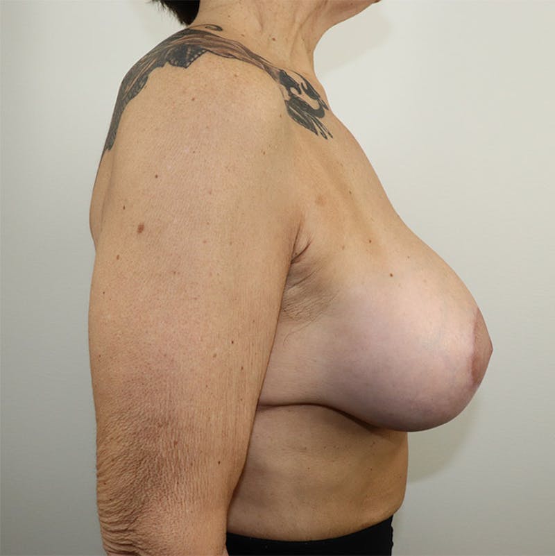 Breast Lift Before & After Gallery - Patient 87555438 - Image 6