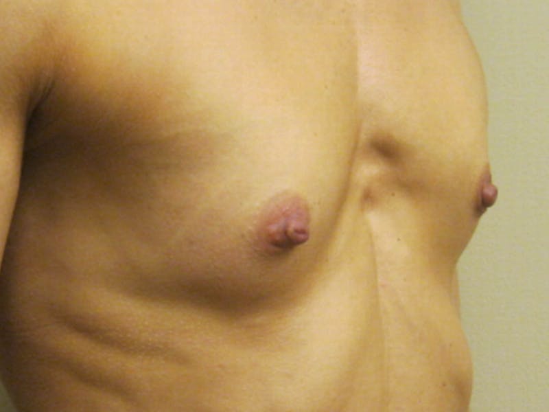 Breast Augmentation Before & After Gallery - Patient 87555442 - Image 1