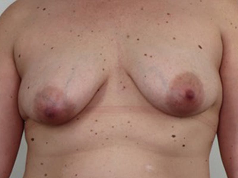 Breast Lift Before & After Gallery - Patient 87555444 - Image 1