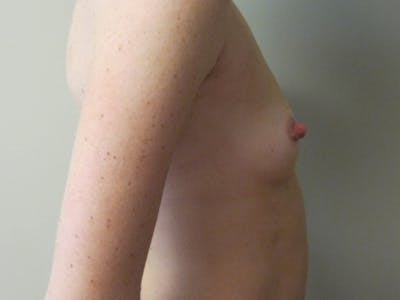 Breast Augmentation Before & After Gallery - Patient 87555446 - Image 1