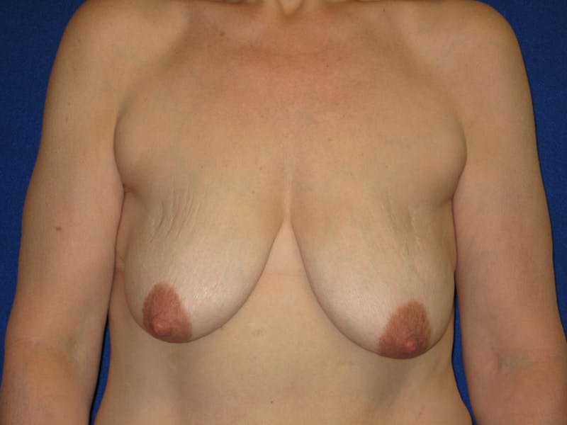 Breast Lift Before & After Gallery - Patient 87555447 - Image 2