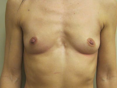 Breast Augmentation Before & After Gallery - Patient 87555454 - Image 1