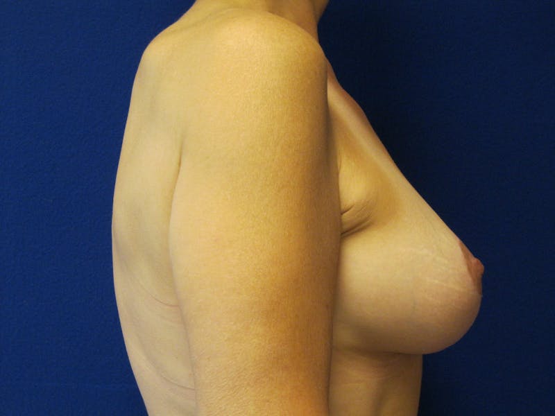 Breast Lift Before & After Gallery - Patient 87555447 - Image 4