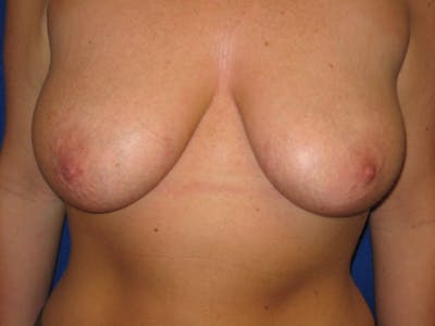 Breast Lift Before & After Gallery - Patient 87555452 - Image 2