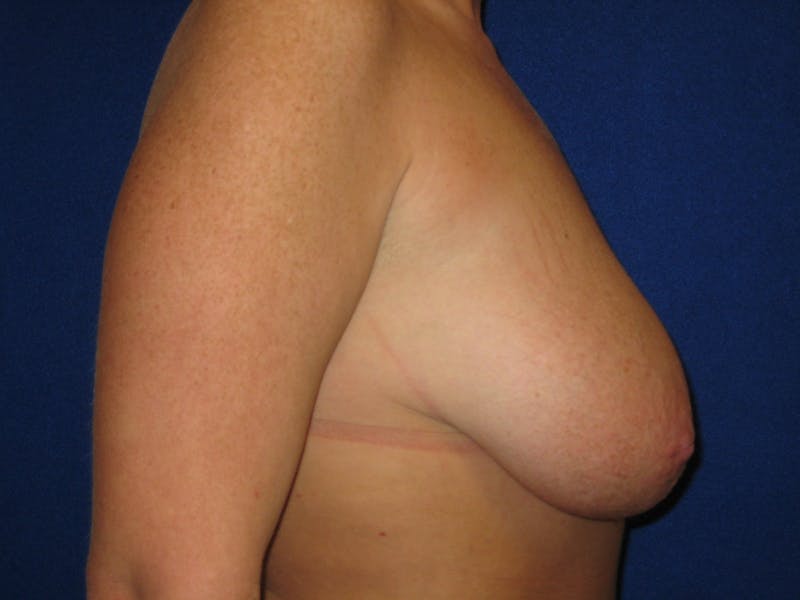 Breast Lift Before & After Gallery - Patient 87555452 - Image 3