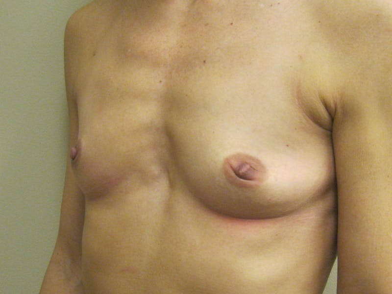 Breast Augmentation Before & After Gallery - Patient 87555454 - Image 5