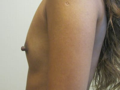Breast Augmentation Before & After Gallery - Patient 87555457 - Image 1