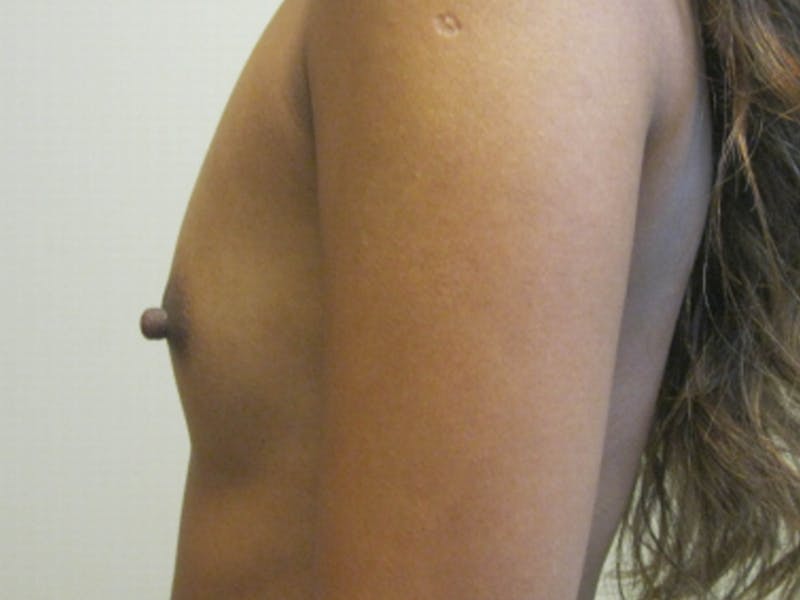 Breast Augmentation Before & After Gallery - Patient 87555457 - Image 1