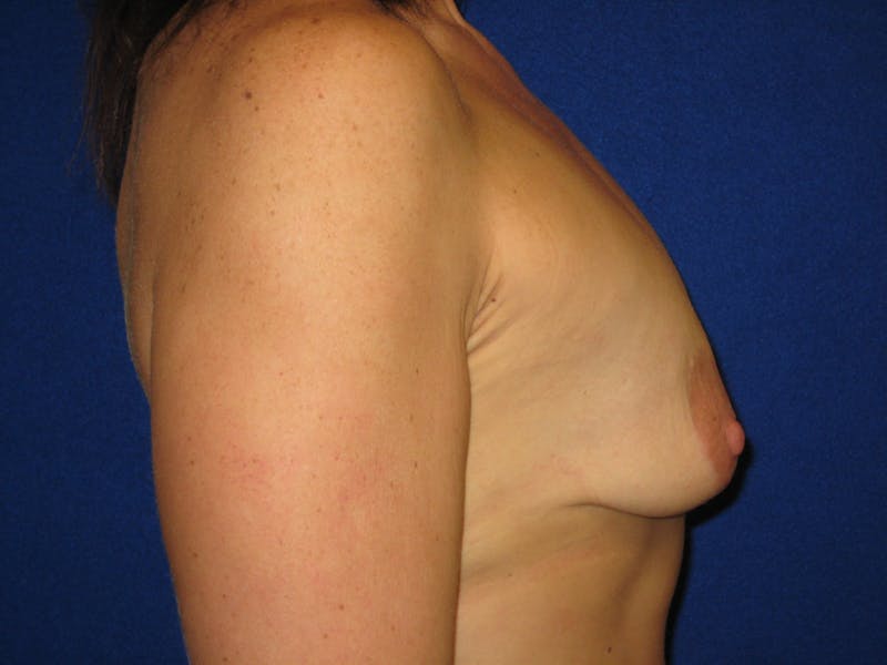Breast Lift Before & After Gallery - Patient 87555458 - Image 3