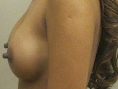 Breast Augmentation Before & After Gallery - Patient 87555457 - Image 2