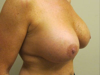 Breast Augmentation Before & After Gallery - Patient 87555463 - Image 2