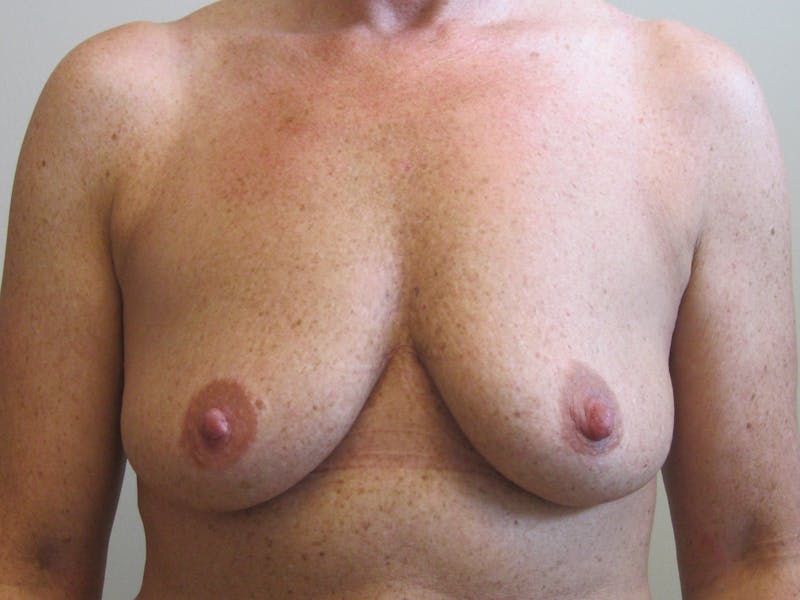 Breast Augmentation Before & After Gallery - Patient 87555463 - Image 3
