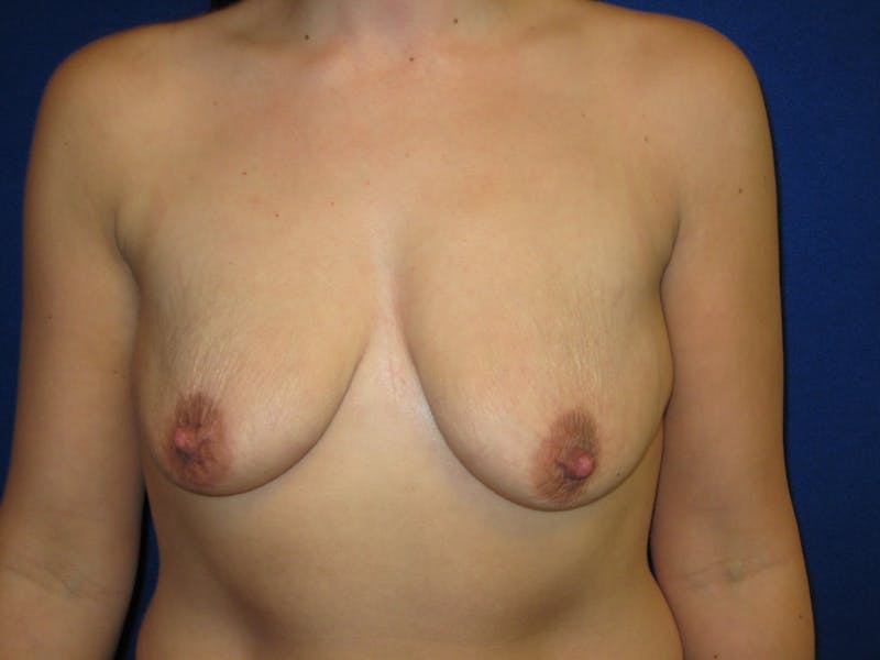 Breast Lift Before & After Gallery - Patient 87555464 - Image 1