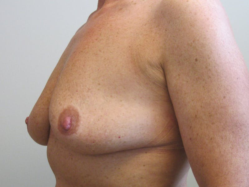 Breast Augmentation Before & After Gallery - Patient 87555463 - Image 5