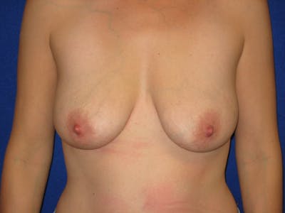 Breast Lift Before & After Gallery - Patient 87563964 - Image 1
