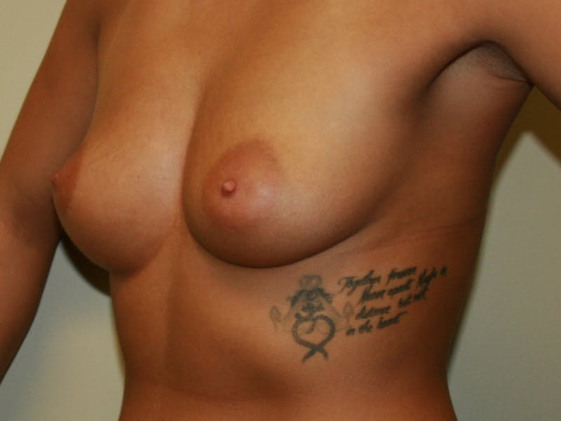 Breast Augmentation Before & After Gallery - Patient 87561467 - Image 3