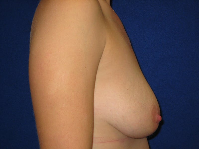 Breast Lift Before & After Gallery - Patient 87563964 - Image 3