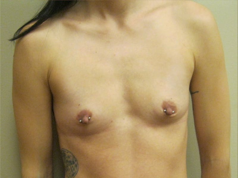 Breast Augmentation Before & After Gallery - Patient 87563967 - Image 3