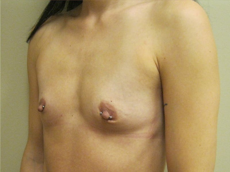 Breast Augmentation Before & After Gallery - Patient 87563967 - Image 5