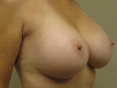 Breast Revision Before & After Gallery - Patient 87563987 - Image 2