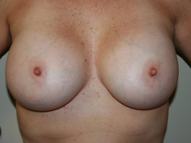 Breast Revision Before & After Gallery - Patient 87563987 - Image 3