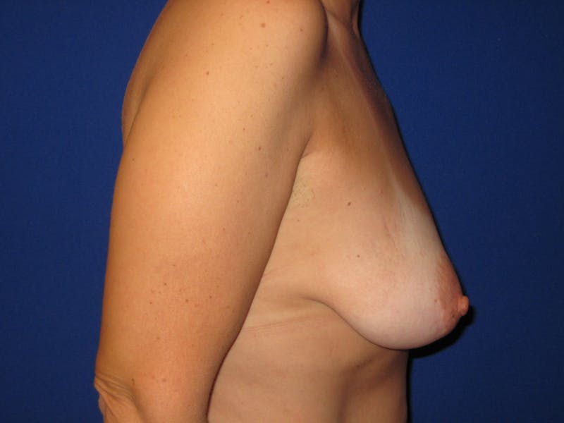 Breast Lift Before & After Gallery - Patient 87563974 - Image 3