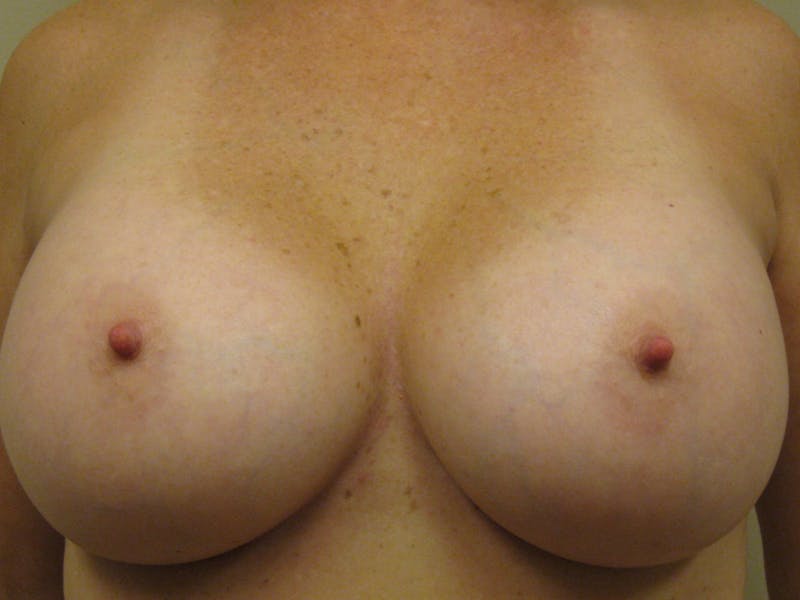 Breast Revision Before & After Gallery - Patient 87563987 - Image 4