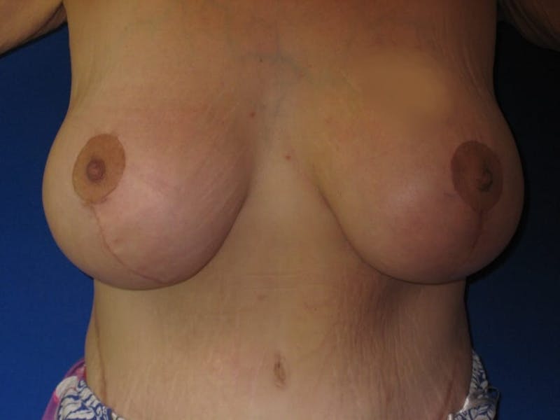 Breast Lift Before & After Gallery - Patient 87563989 - Image 2
