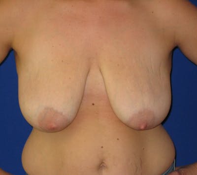 Breast Lift Before & After Gallery - Patient 87563990 - Image 1